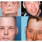 man-face-transplant-after-gunshot-injury