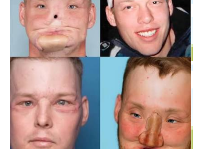 man-face-transplant-after-gunshot-injury