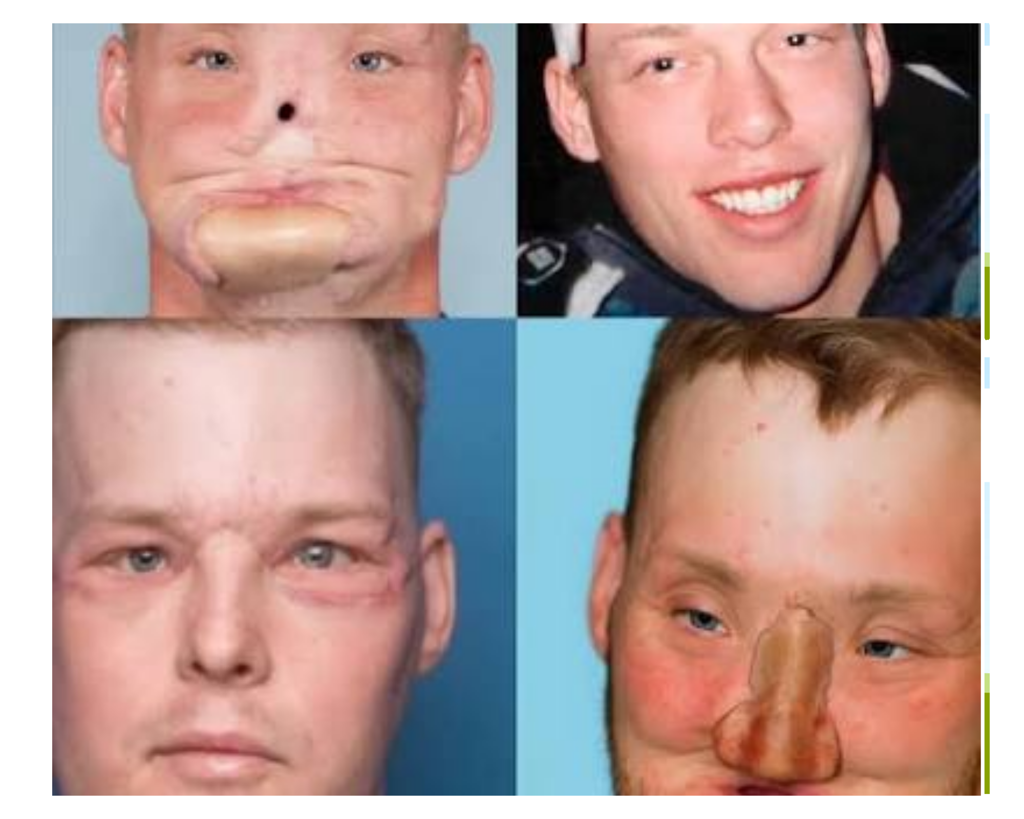 man-face-transplant-after-gunshot-injury